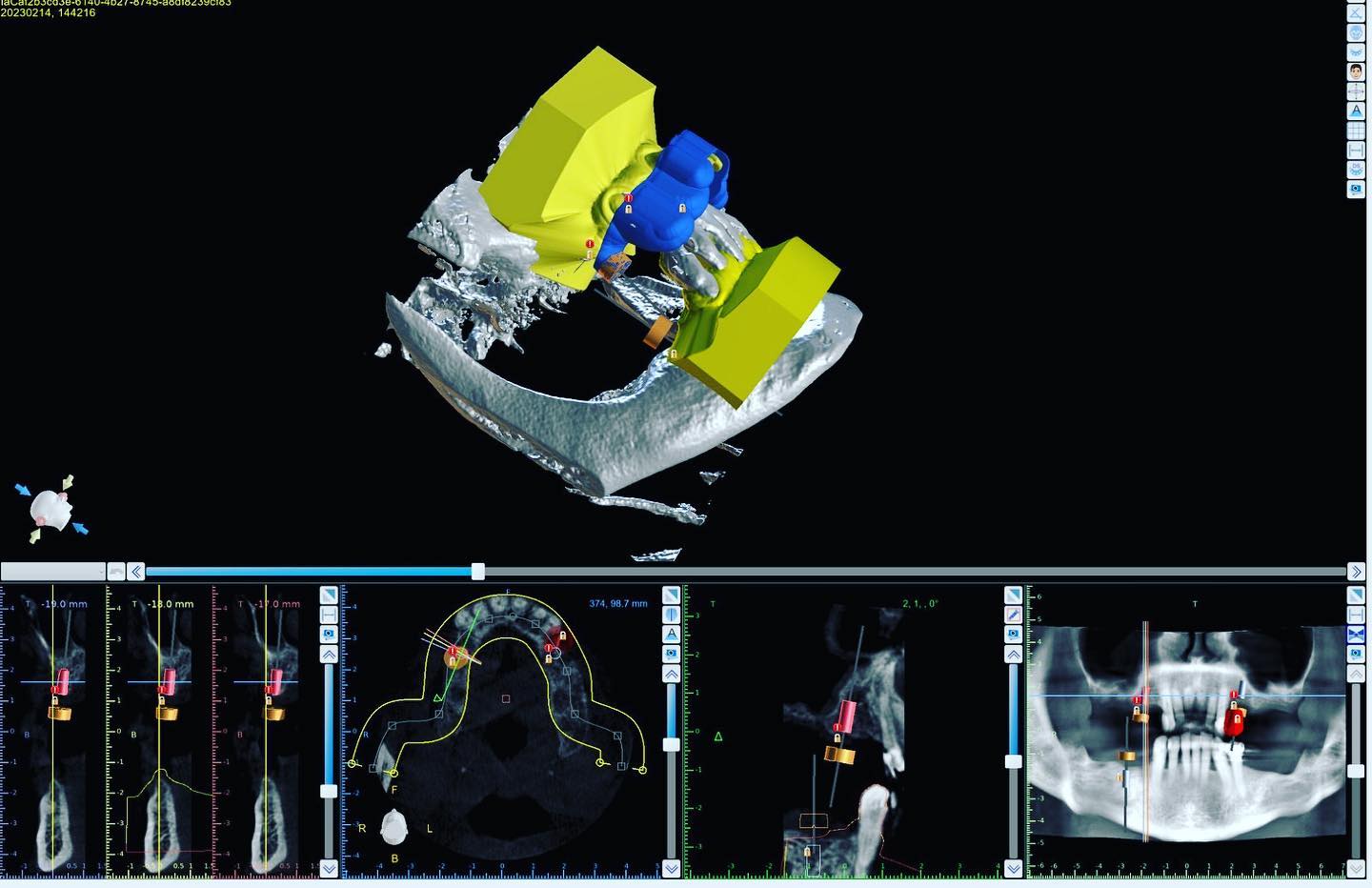 Implant restoration planning work
