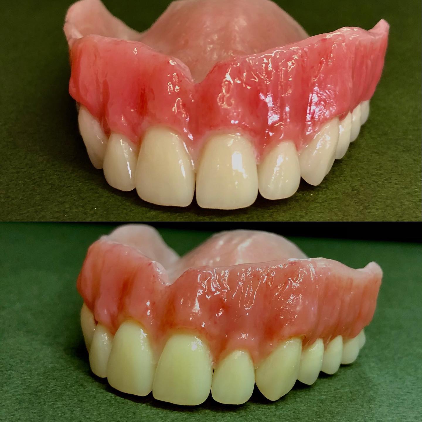 Removable prosthetic case